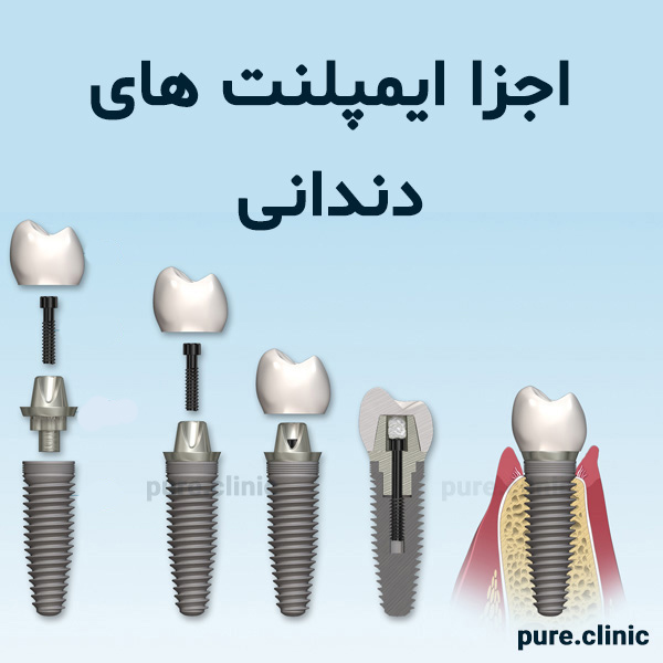 اجزا ایمپلنت های دندانی