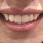 ایمپلنت در دندان های قدامی