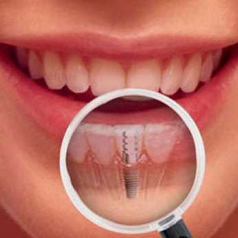 مزایای ایمپلنت های دندانی