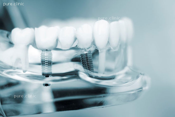 معیارهای موفقیت ایمپلنت های دندانی