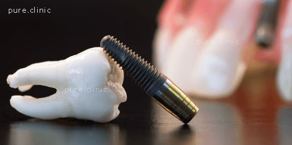 معیارهای موفقیت ایمپلنت های دندانی