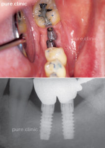 تاثیر متقابل ایمپلنت روی دندان‌های مجاور