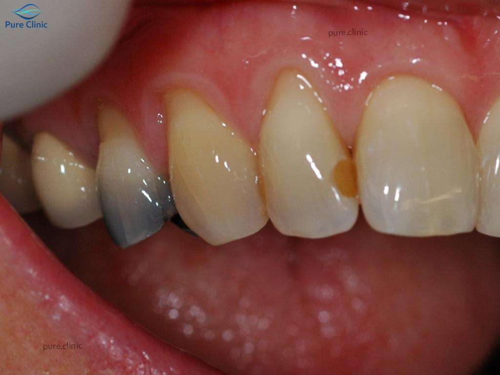علل تغییر رنگ دندان