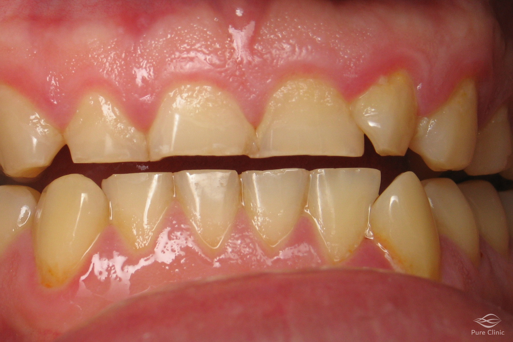 سایش های دندانی