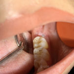 جراحی دندان عقل