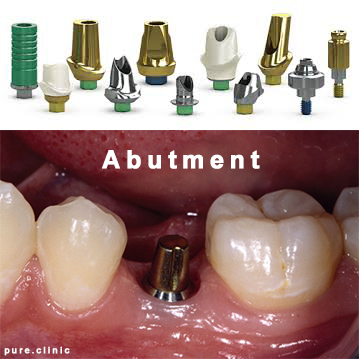 اجزا ایمپلنت های دندانی