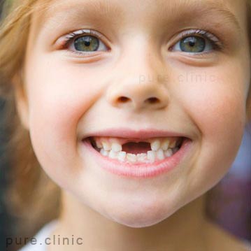ایمپلنت دندانی در کودکان و نوجوانان