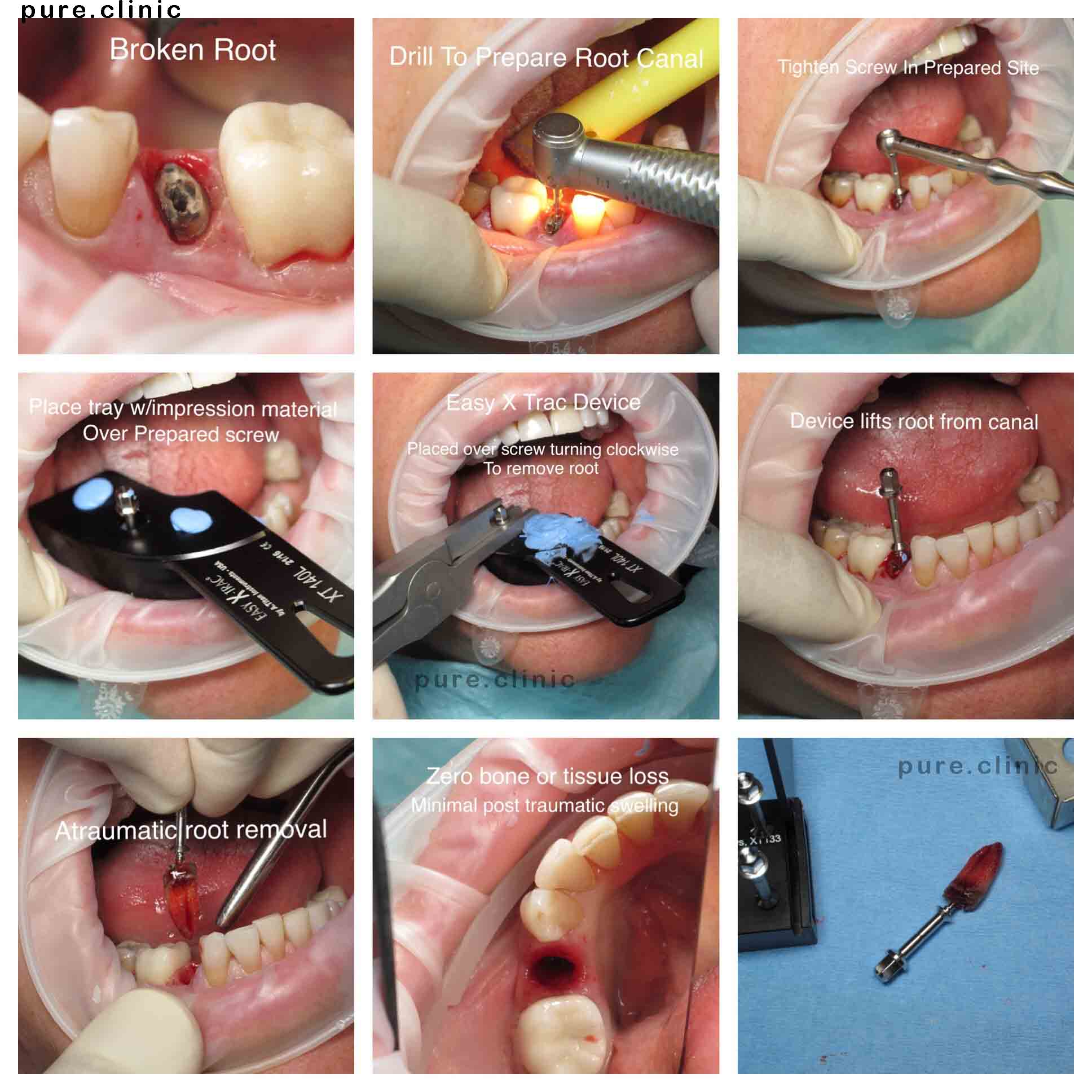 کشیدن غیر تهاجمی دندان