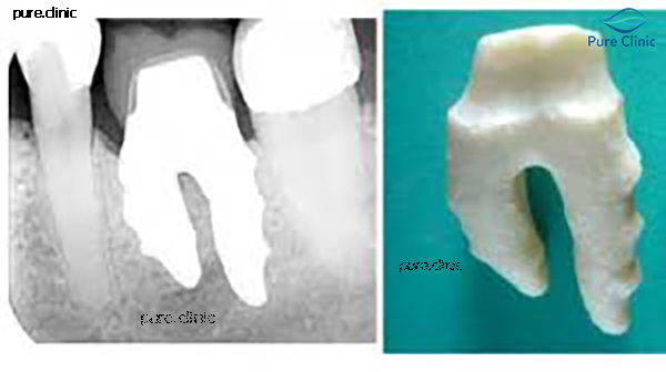 ایمپلنت های شکل دندان
