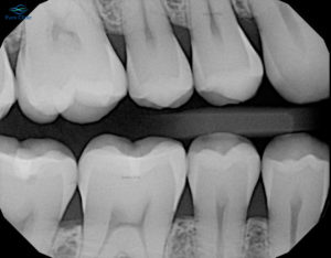 رادیوگرافی دندانی