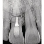 رادیوگرافی دندانی